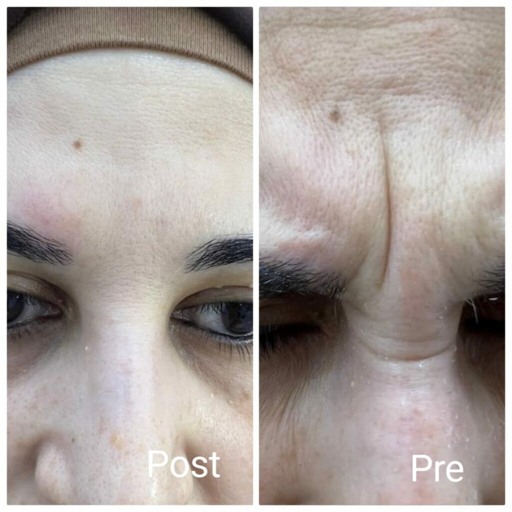 Botox injections to remove wrinkles